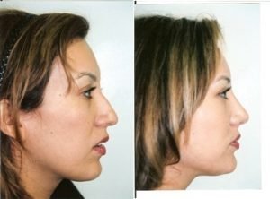 nose_surgery_case3-1