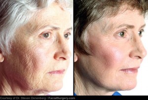 webmd_rm_photo_of_before_and_after_neck_lift