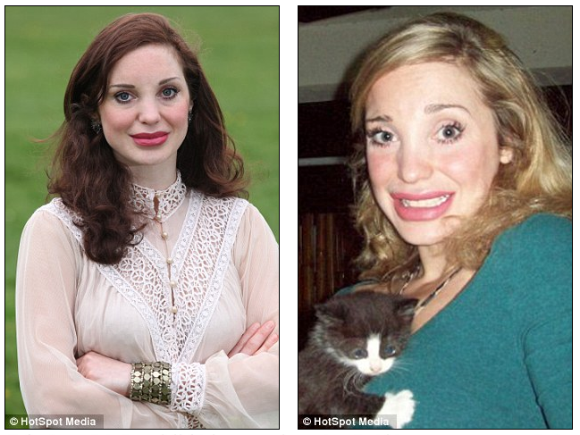 bad lip injections Screen Shot 2012-05-14 at 9.41.13 AM