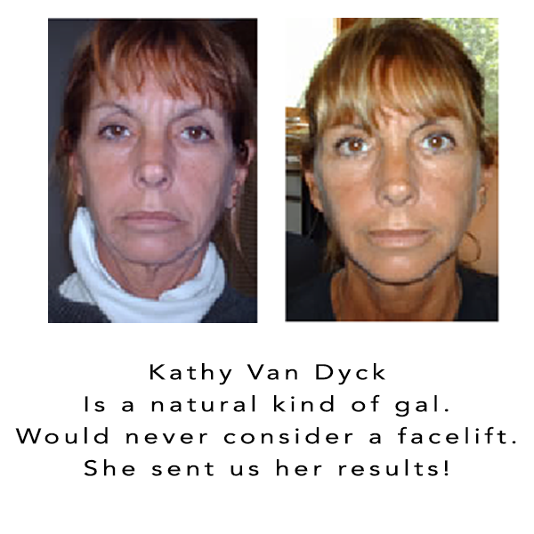 Facial Magic Before and AFter