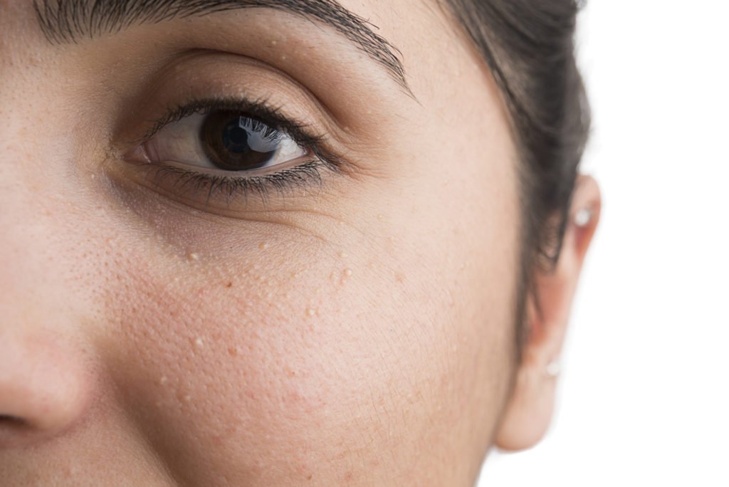 milia on a woman's face