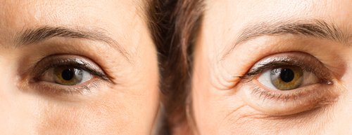how to get rid of crows feet
